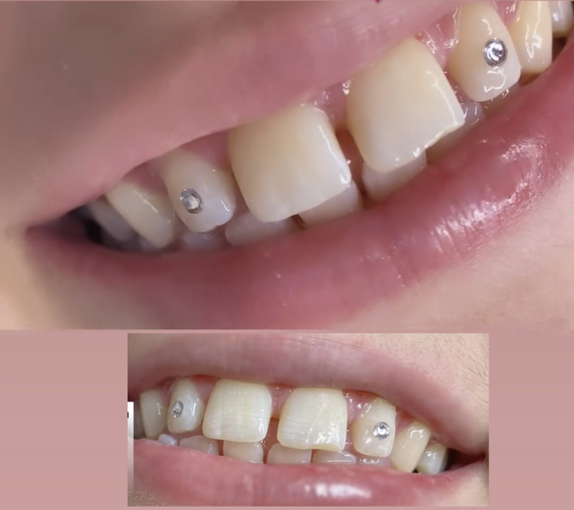 Individual Teeth Gems💎