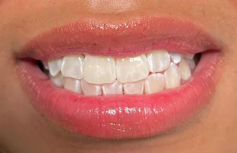1 Hr Whitening for Sensitive Teeth