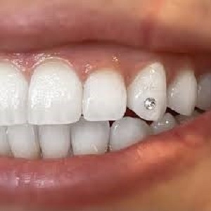 Single Tooth Gem