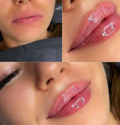 Black Friday 1/2 Syringe [$250]