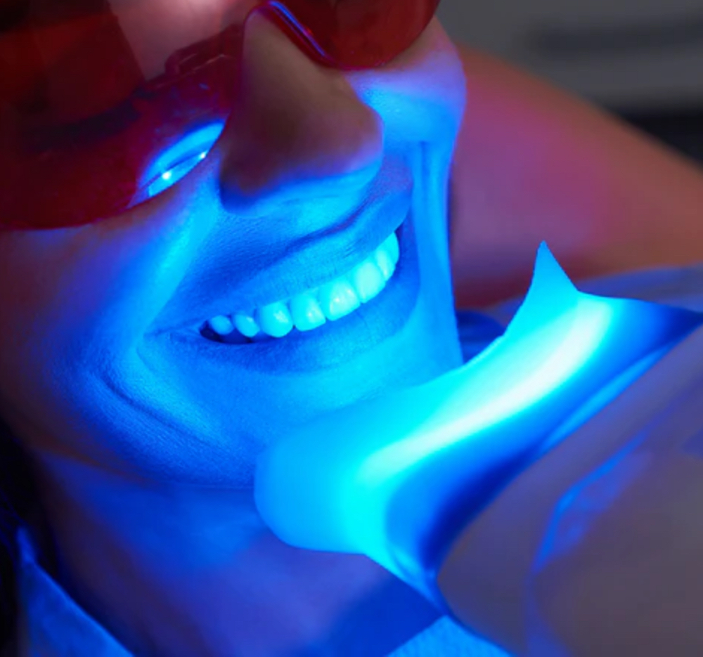 Teeth Whitening