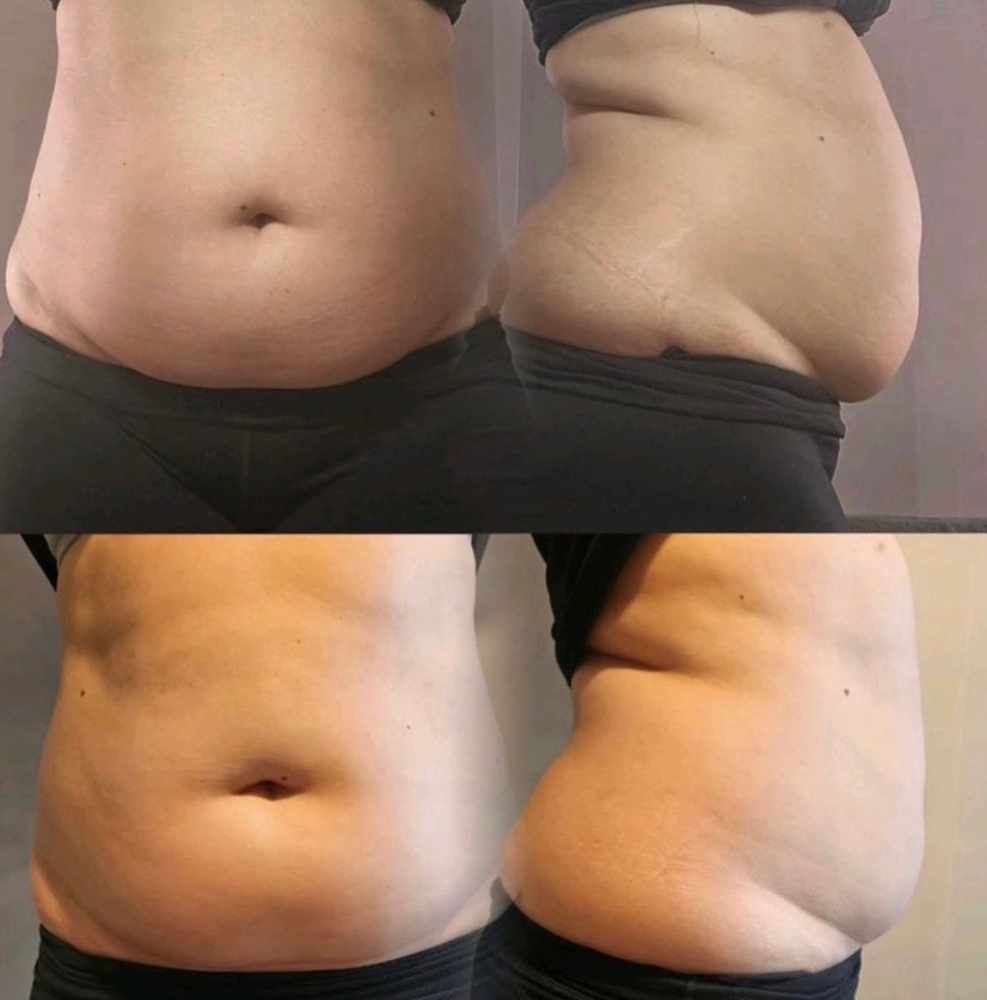EXPRESS LIPO