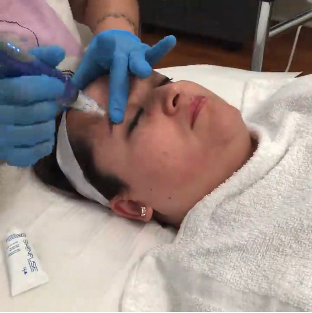 Microneedling “Feel Radiant”
