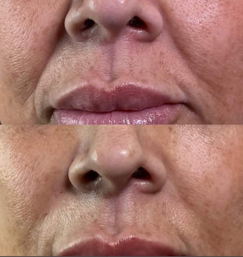 Nasolabial Folds (smile Lines)