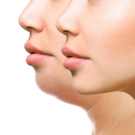 Double Chin Remover