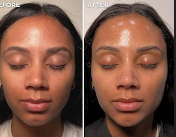 Dermaplan & HydraFacial