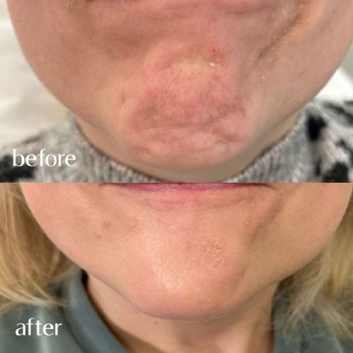 Chin Botox at PuraGlow Aesthetic in Oklahoma City, OK