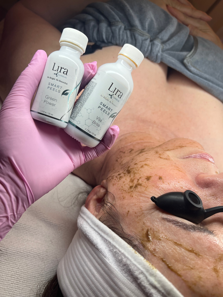 Level 2  Chemical Peel