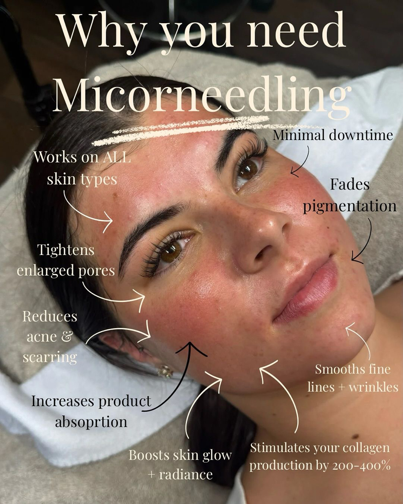 Rejuvenation Microneedling Facial at Studio Glow Esthetics By Ashten in Coshocton, OH