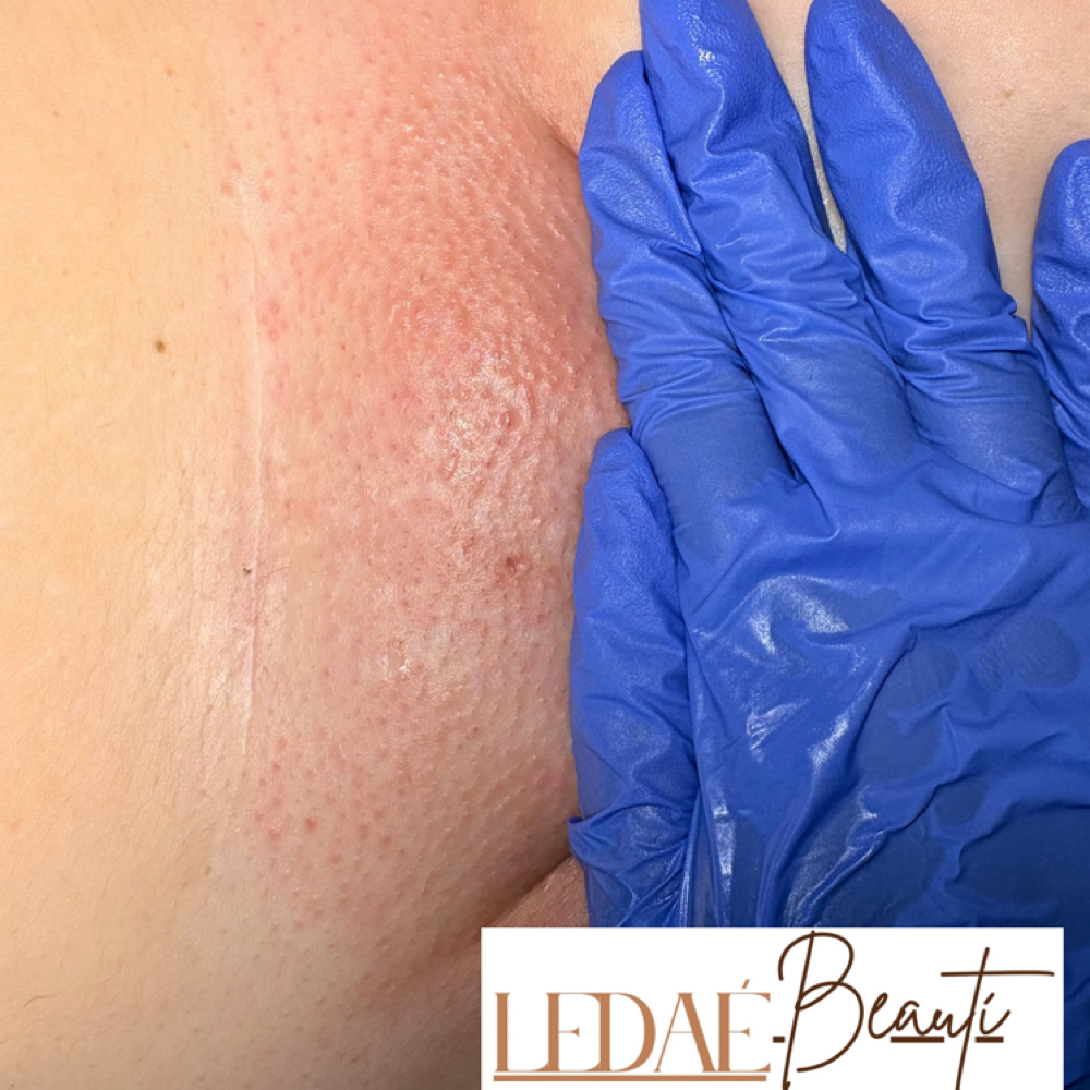 Brazilian Wax + Advanced Ingrown Tr at LeDaé Beautí in Lafayette, LA