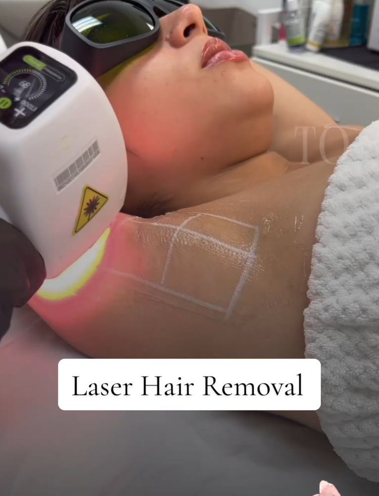 Laser Hair Removal By Sarah