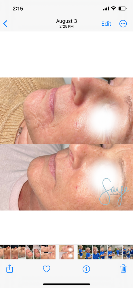 Saije Platinum RF Microneedling