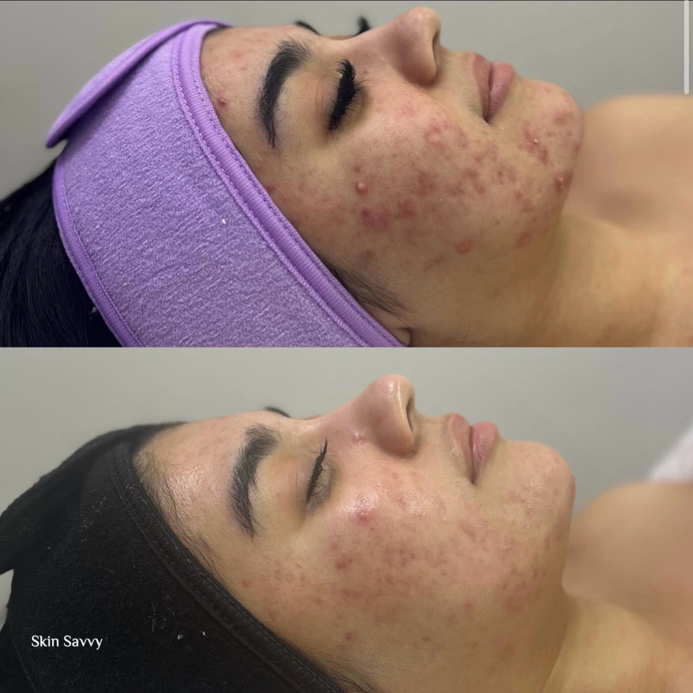 Skin Savvy Clear Method at Skin Savvy SATX in San Antonio, TX
