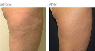 Radiofrequency Cellulite Treatment