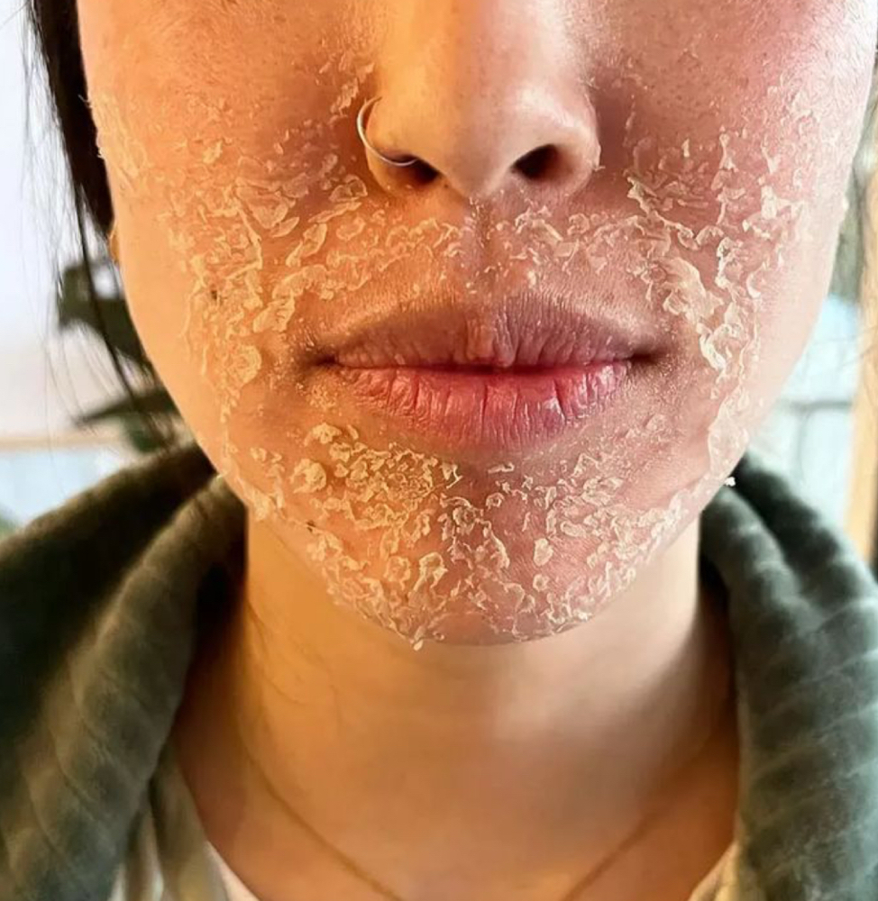 Chemical Peel