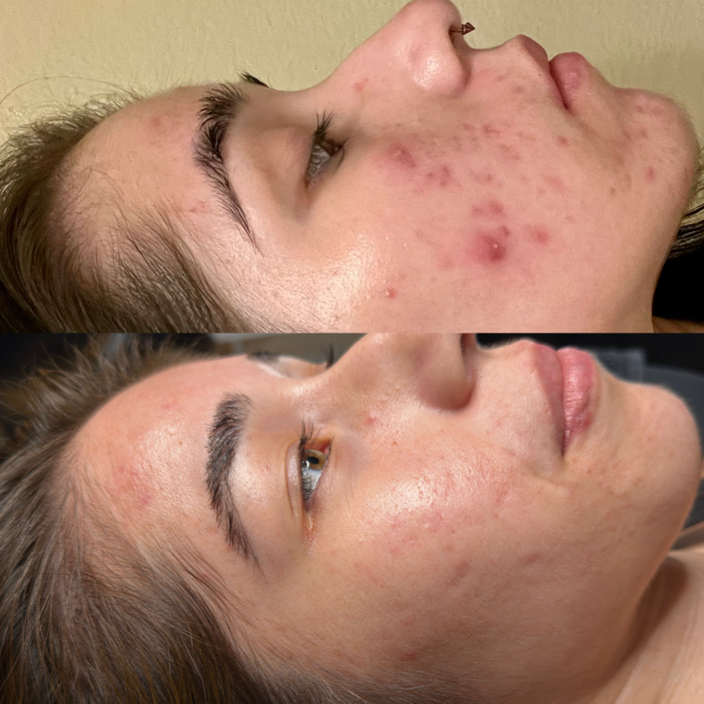 PROCELL MICROCHANNELING + STEM CELL at Etched and Elegant in Corona, CA