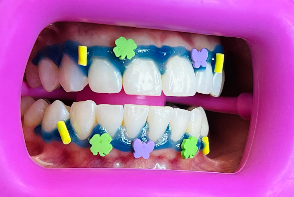 Whitening Maintenance