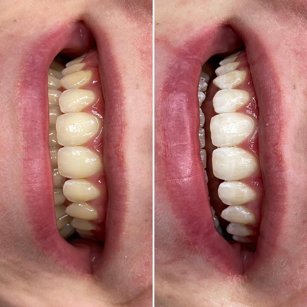 Teeth Whitening at Christina’s Cosmetics in Jerome, ID