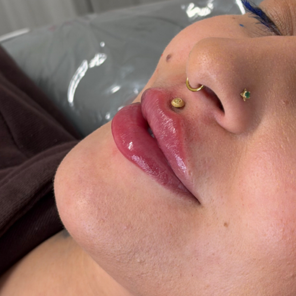 Lip Filler 0.5 ML at Elevé Esthetics in Chicago, IL