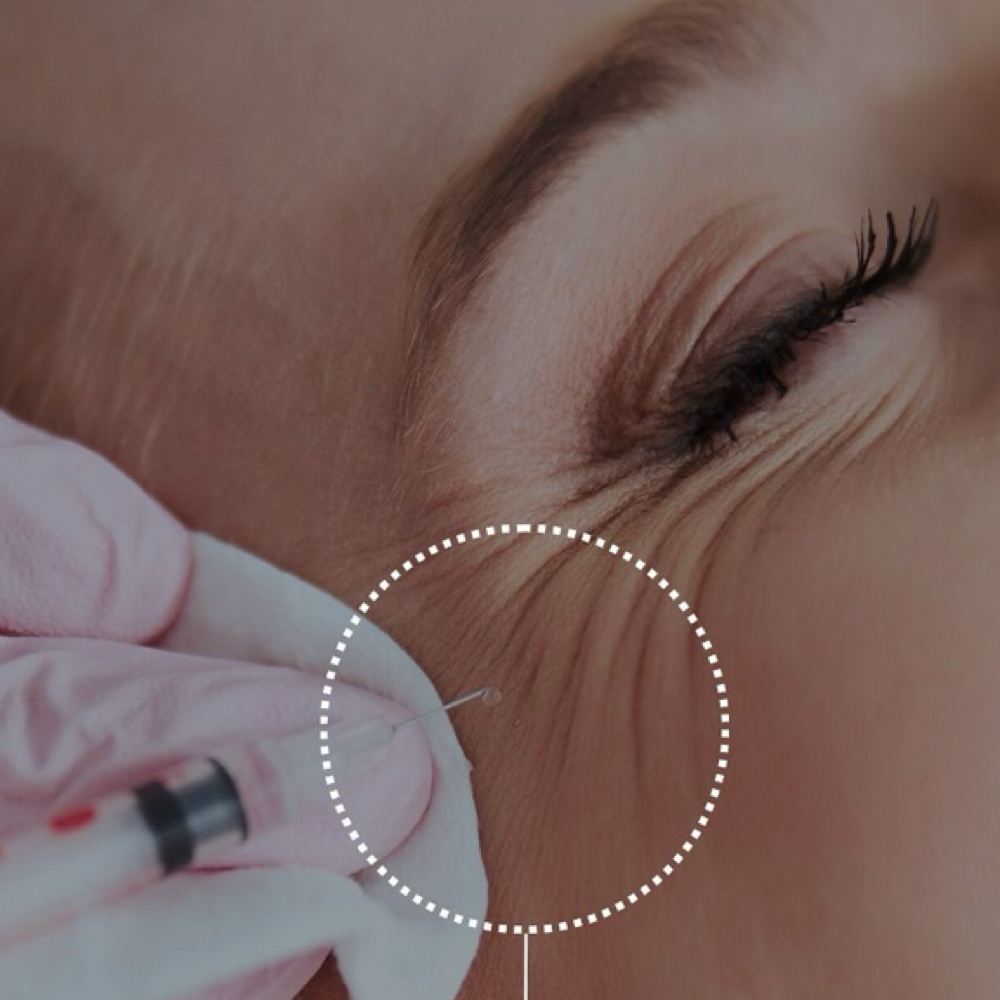Botox- Crows Feet at Groomsology MedSpa in Mt Orab, OH