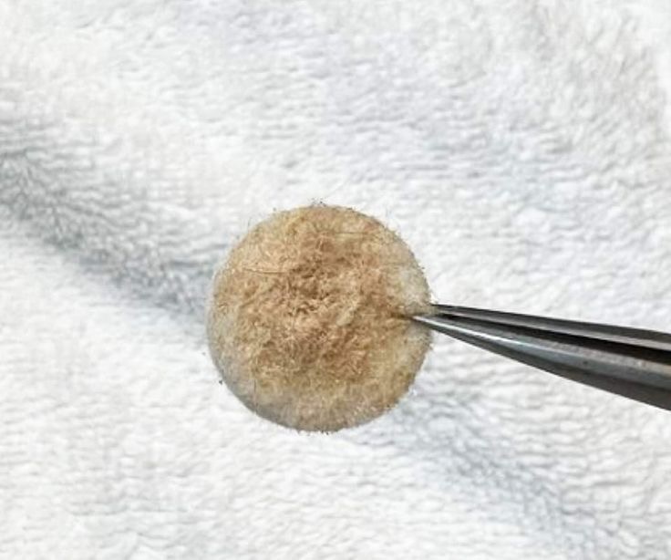 Microdermabrasion facial