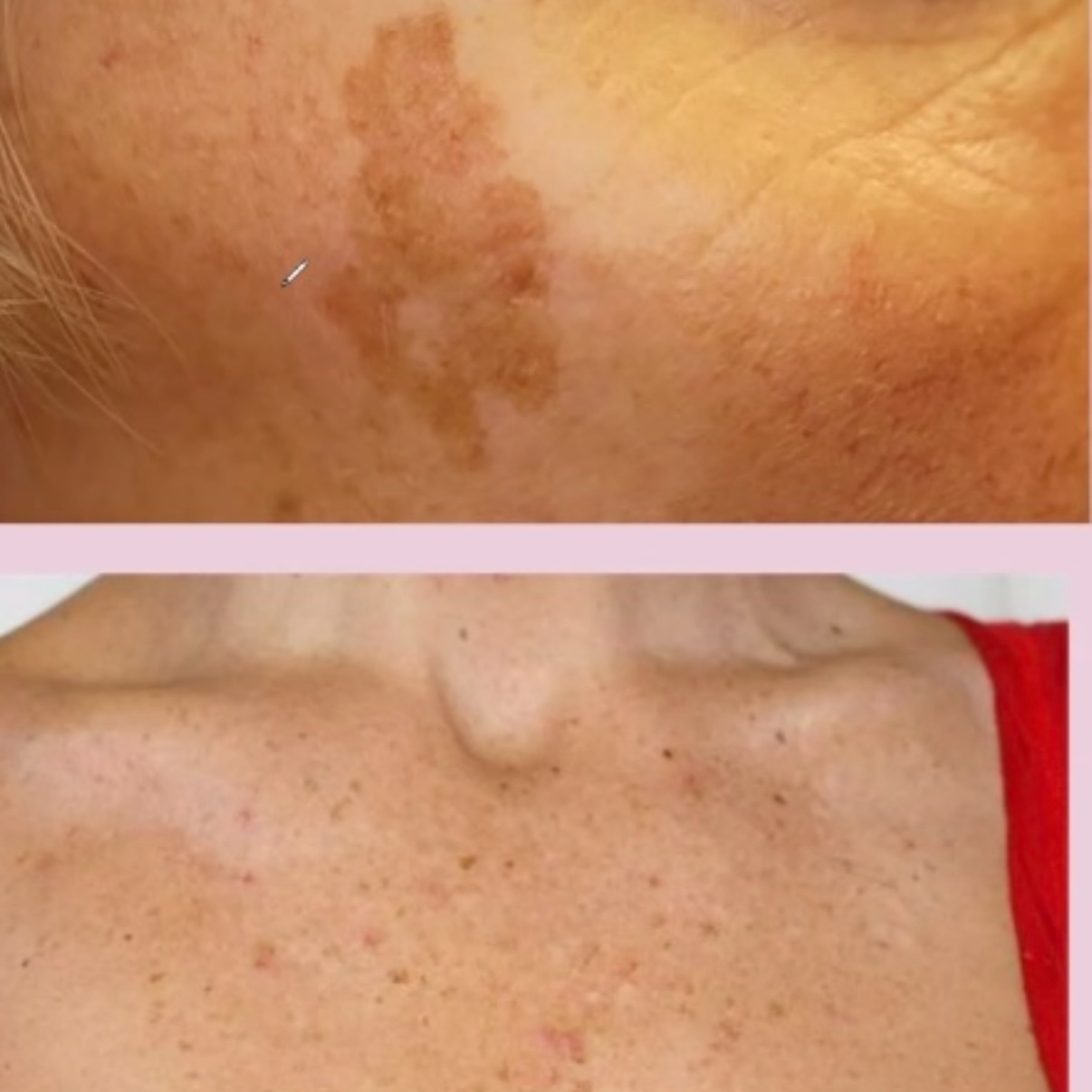Flat Hyperpigmentation Removal at Serenity Aesthetics by Denise in St. John’s, FL