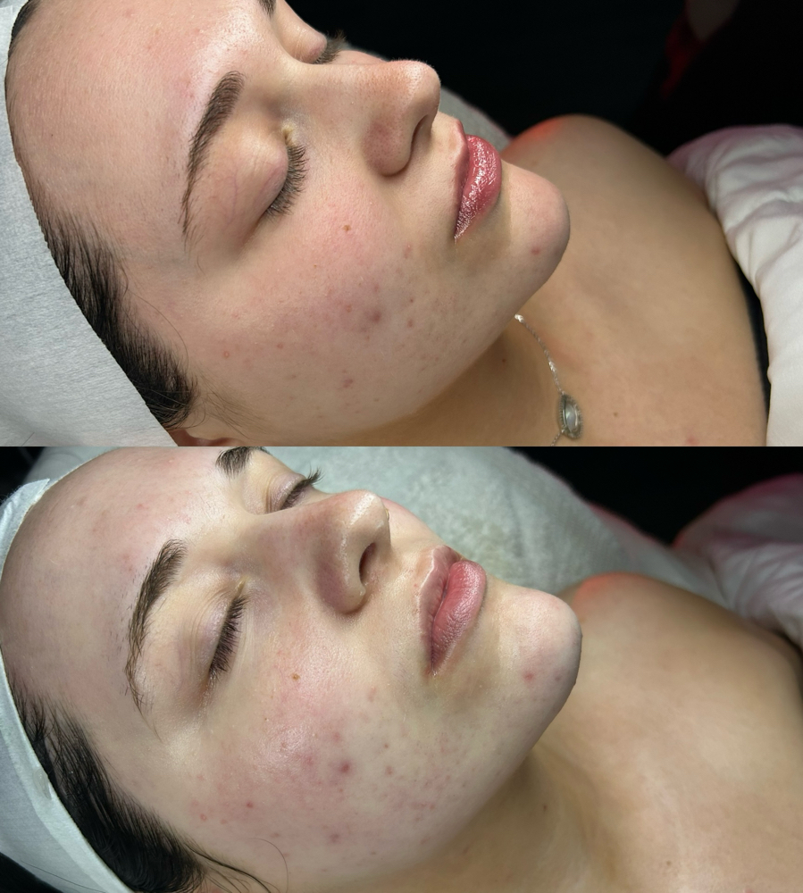 Glass Skin Facial