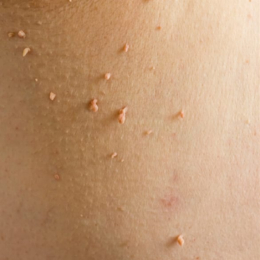 Skin Tag Removal at Bare Beauty Method LLC in Leander, TX