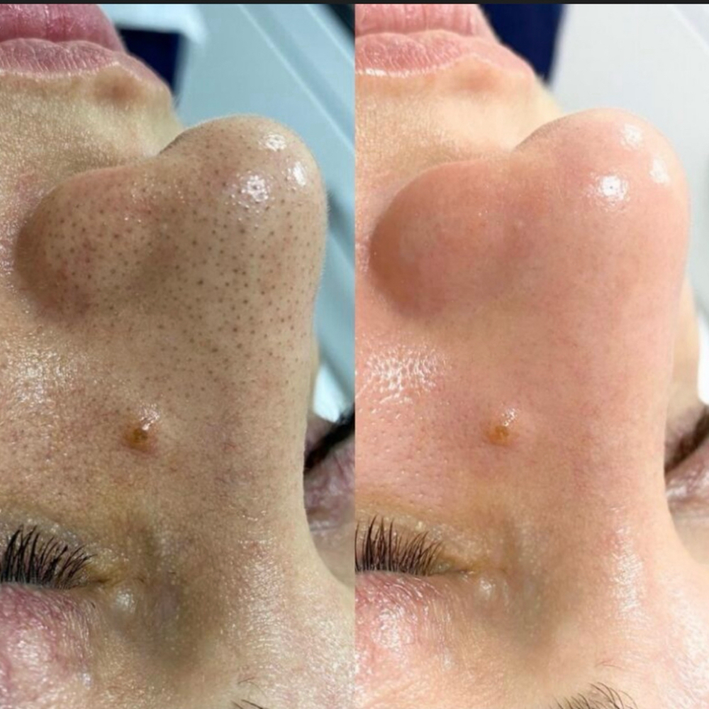 Deep Pore Cleansing Facial