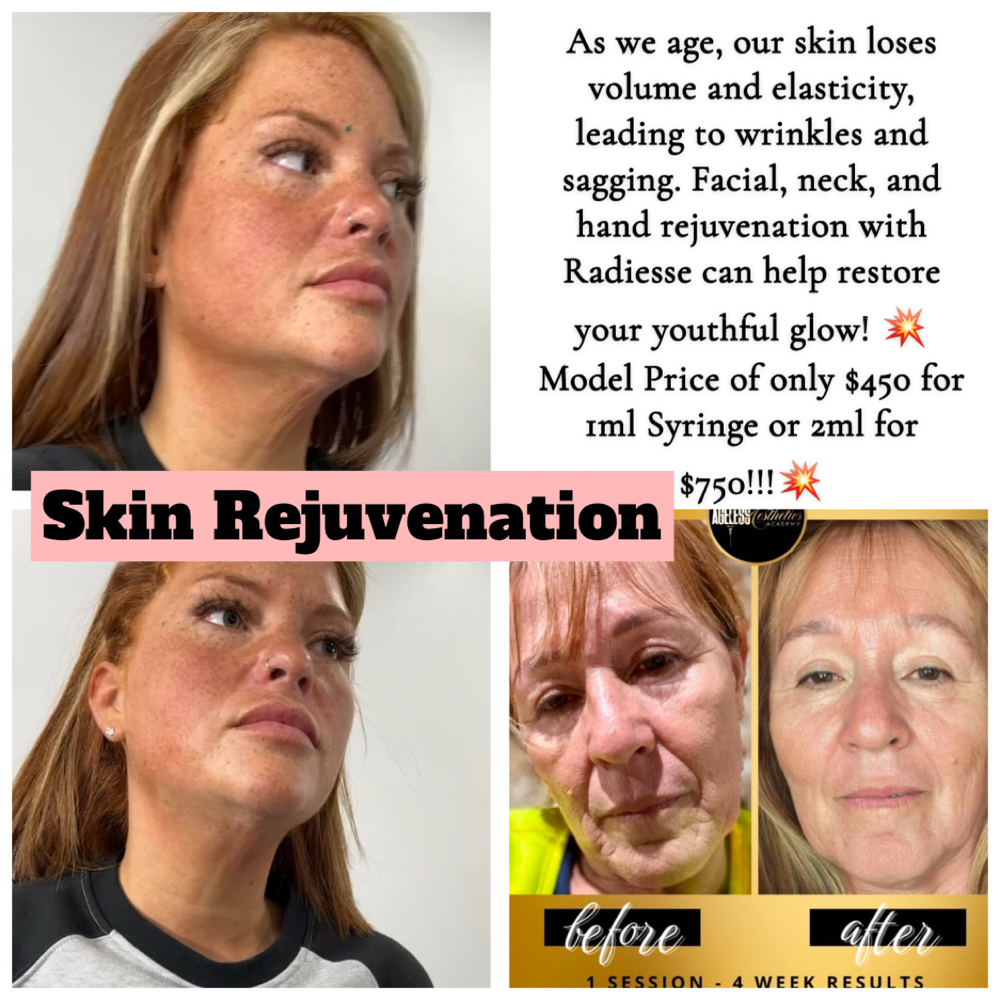 Neck Rejuvenation