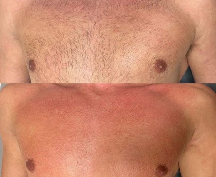 Chest Wax at Haus Of Skin in Burleson, TX