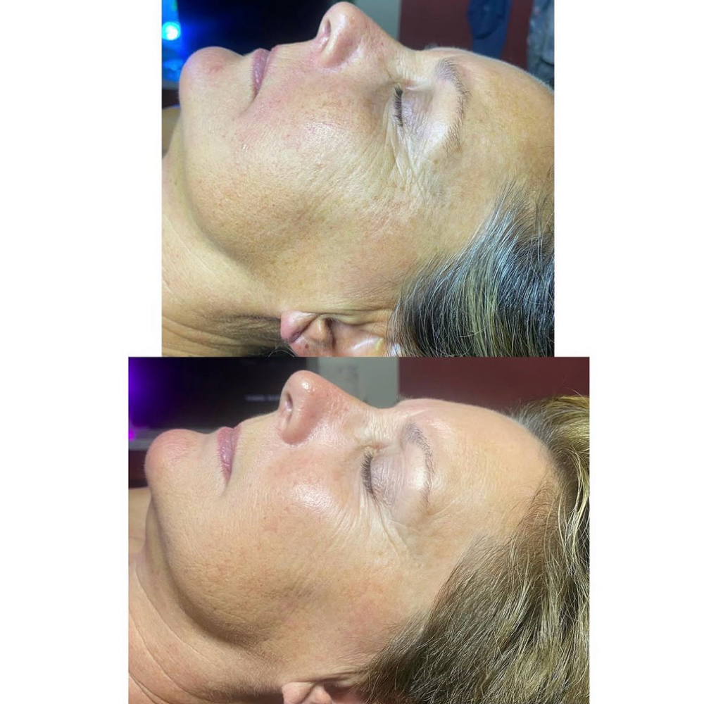 Anti Agining Facial at Volimé Esthetics in Haslett, MI