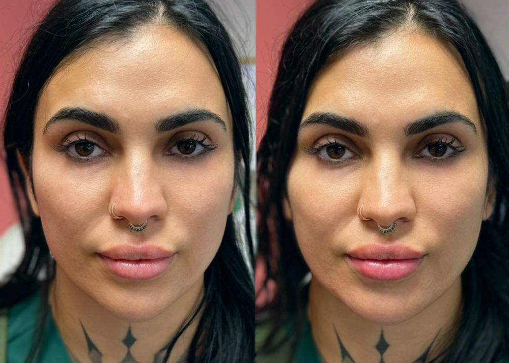 Facial Profile Balancing