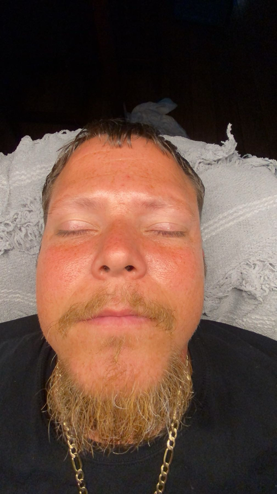 May Microdermabrasion