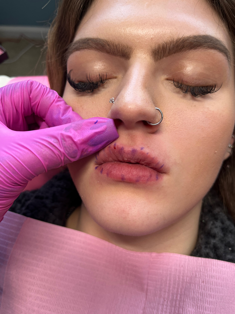 Lip Filler Consultation