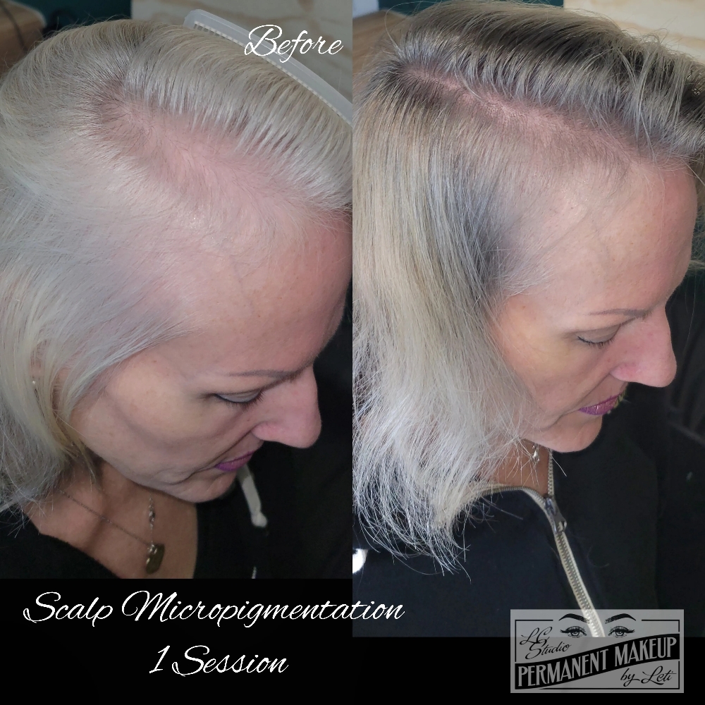 Scalp Micropigmentation