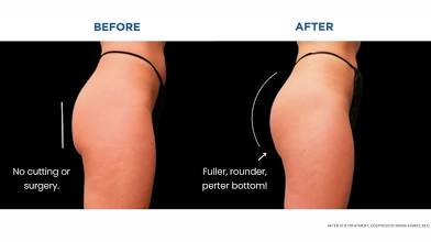 Snatched Waist + Booty Lift Package