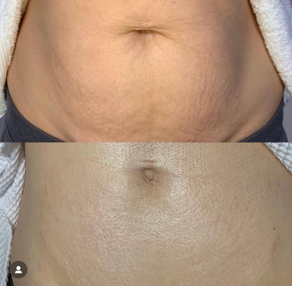 Tummy Tightening Fibroblasting