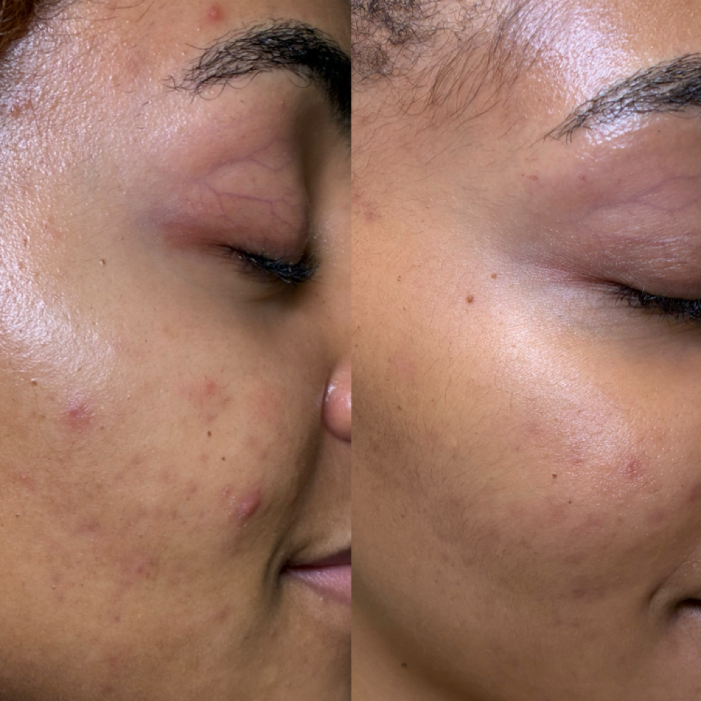 Microneedling at Oasiah Aesthetics in New York, NY
