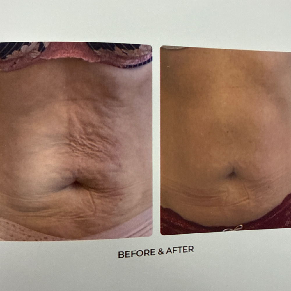 T-Shape 2 Body Shaping at You…Only Better in Kansas City, MO