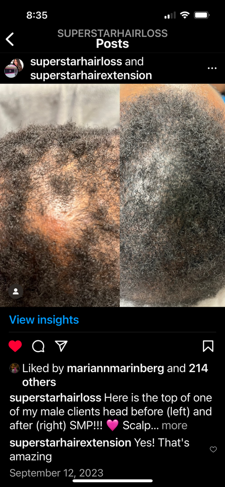 Scalp micro Pigmentation