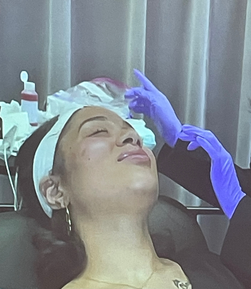 Microneedling Model