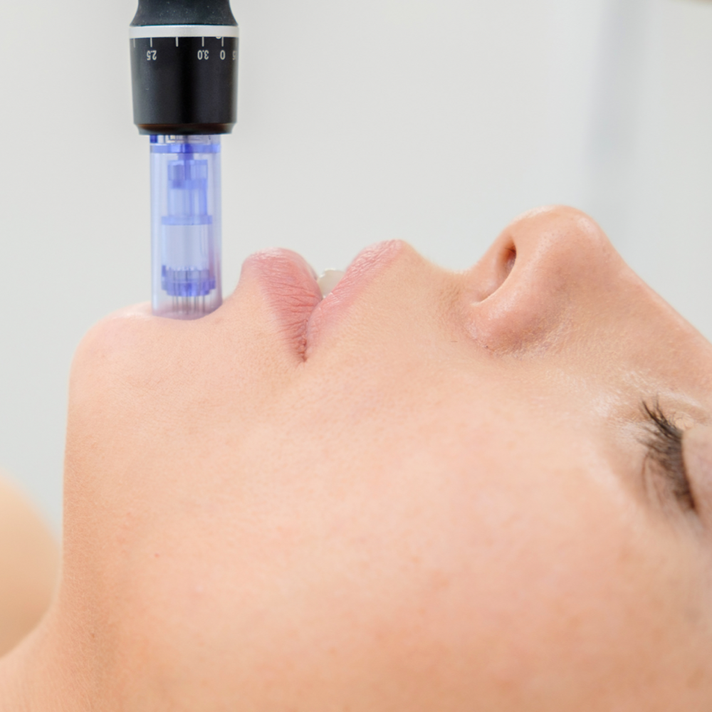 Microneedling