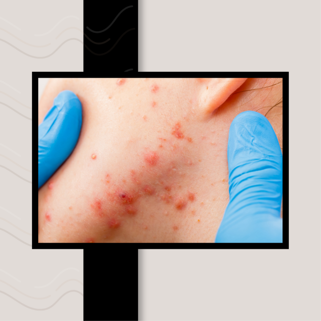 Two Week Acne Check-In + Treatment at Skin By Becca in Holly Springs, NC