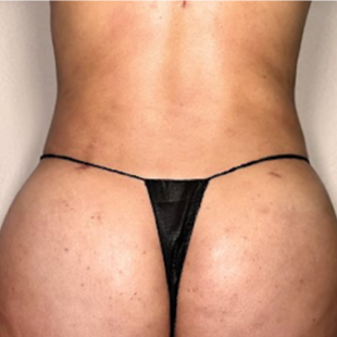 Post OP Lynpathic massage at Infinity Beauty BlancaG in Denton, TX