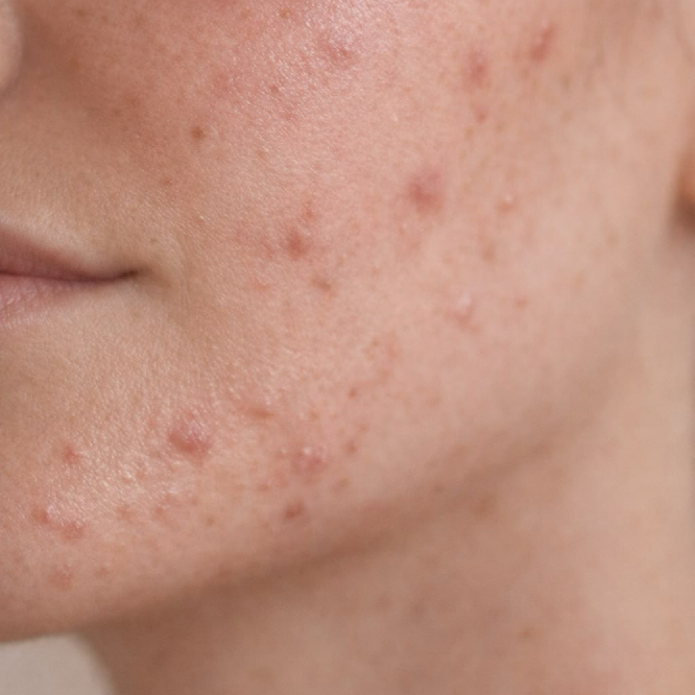 Acne Clarifying Facial at Beauty & Skin by Tristin in Russellville, KY