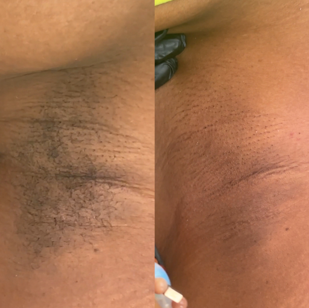 Underarm Wax at revamp in St. Louis, MO