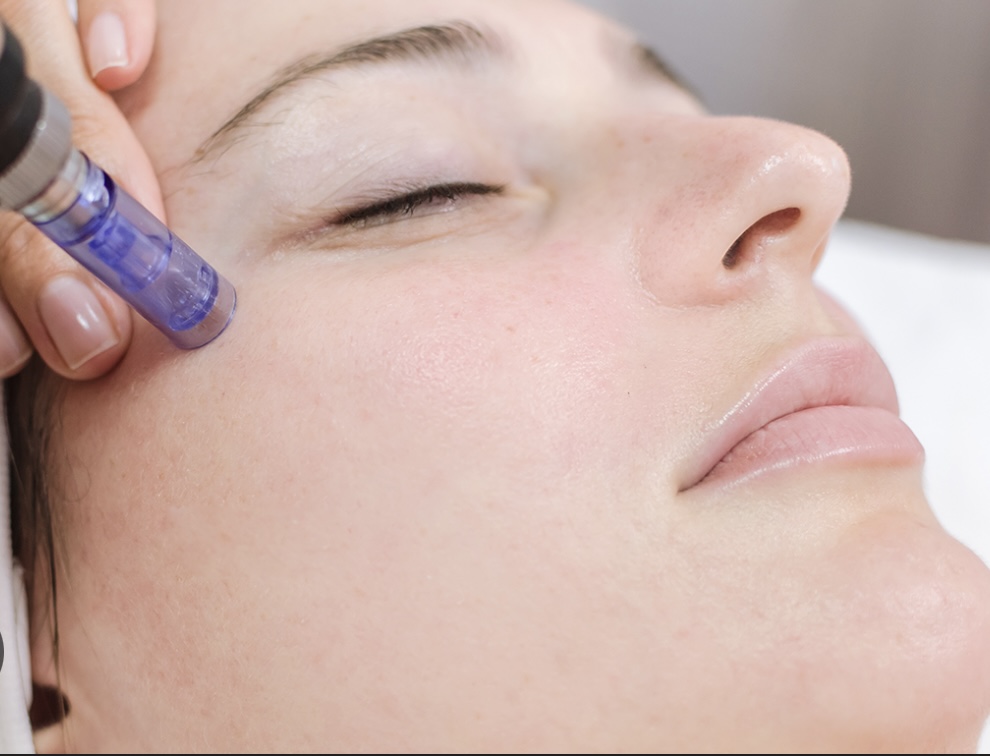 Microneedling + Skin Booster at 🤍pSb Luxe Beauty🤍 in Tottenville, NY