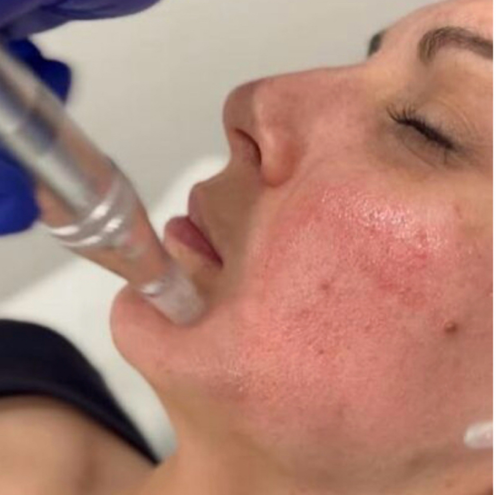 Microneedling Facial at Gardenias Beauty Salon in North Charleston, SC