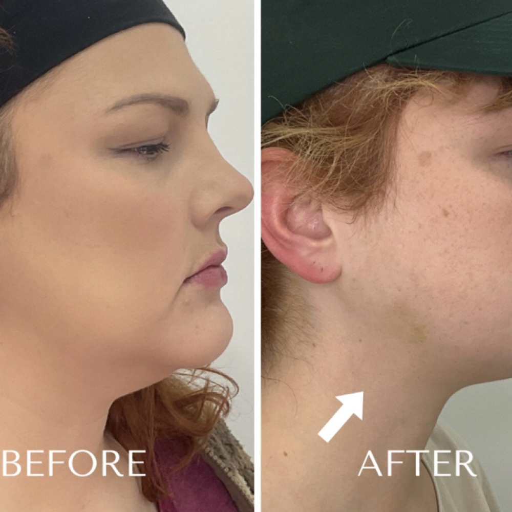 Chin Fat Dissolve 3 Sessions at Skin Flip Aesthetics by Nurse O in Woodlawn, MD
